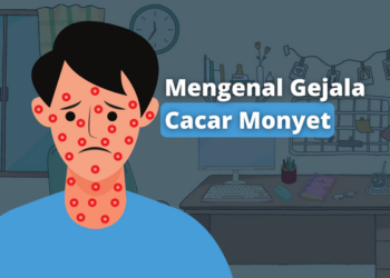 Mengenal Gejala Cacar Monyet