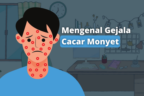 Mengenal Gejala Cacar Monyet