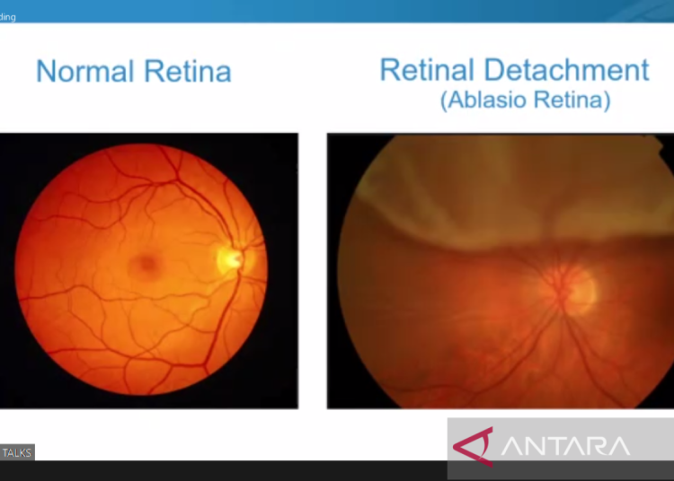 Usia 40 tahun ke atas rentan terkena ablasio retina