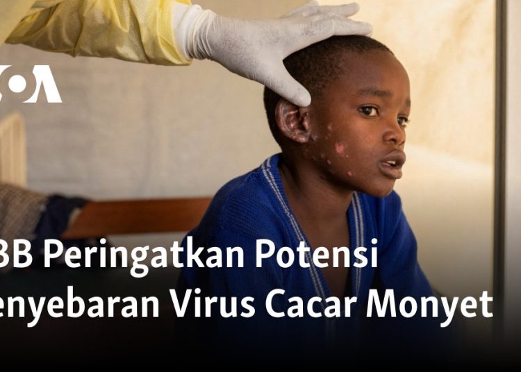 PBB Peringatkan Potensi Penyebaran Virus Cacar Monyet