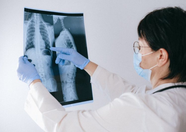 Gejala kanker paru yang perlu diwaspadai dan perlu deteksi dini