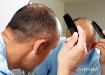 Mencegah kebotakan di usia 30an menurut dokter