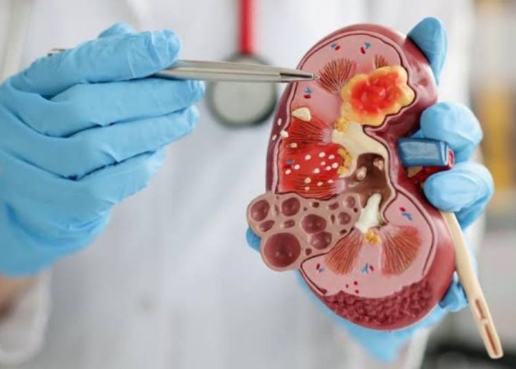 Konsumsi obat sembarangan bisa picu gagal ginjal