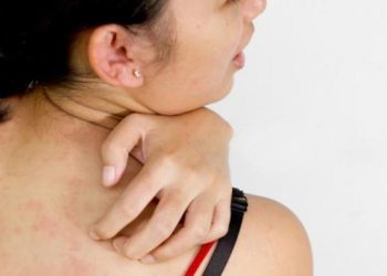Penderita diabetes dan obesitas rentan terkena jamur di kulit