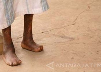 Dokter Rehabilitasi ungkap pencegahan kusta jadi hal krusial dilakukan